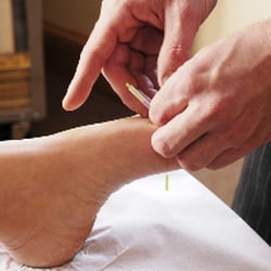 Fusion Life Spa - Acupuncture Treatment