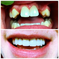 Freedom Family Dental - Fort Worth - We are here to help patients know their options to replace missing teeth.
