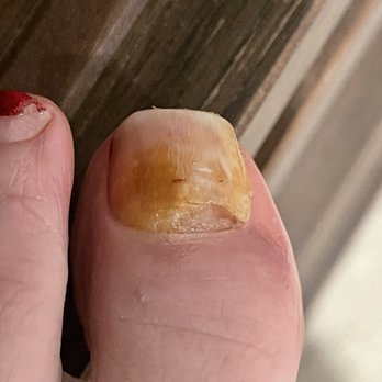 Ritz Nails - Ritz nails - infected toe and total nightmare - Nail Salons Near Me - Tustin, California Ritz Nails - Ritz nails - infected toe and total nightmare - Nail Salons Near Me - Tustin, California