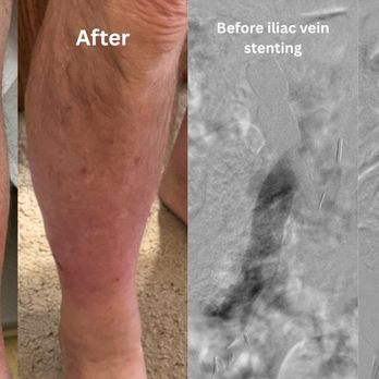 Advanced Surgical Care - Recurrent varicose veins in a young male patient, when should we start looking at iliac veins as part of routine evaluation? - Surgeons Near Me - Reno, Nevada Advanced Surgical Care - Recurrent varicose veins in a young male patient, when should we start looking at iliac veins as part of routine evaluation? - Surgeons Near Me - Reno, Nevada
