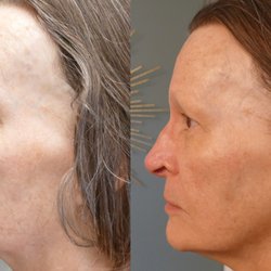 Body Frame Spa - 8 Point Face Lift Facial before and after photo