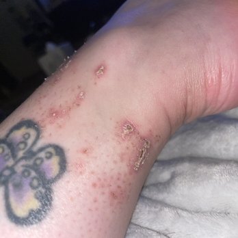 Fresh Nails & Spa - 3 weeks later, the areas of worst burns are still covered in scabs. - Nail Salons Near Me - Las Vegas, Nevada Fresh Nails & Spa - 3 weeks later, the areas of worst burns are still covered in scabs. - Nail Salons Near Me - Las Vegas, Nevada