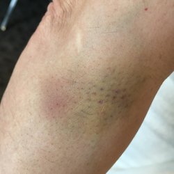 Louise Medical Center - Other bruises