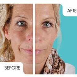 Frank J Scaccia MD - Before and After and Facial Creams supplied for Home use in the extension of lift.