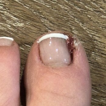 Elite Nails And Spa - This is how my toe looked leaving. Awful! - Nail Salons Near Me - Simi Valley, California
