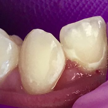 Yu Jocelyn E, DDS - Inflamed gums - Pediatric Dentists Near Me - The Colony, Texas Yu Jocelyn E, DDS - Inflamed gums - Pediatric Dentists Near Me - The Colony, Texas