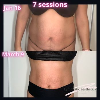 Lymphatic Aesthetics - Lets us help you reach your body Goals! - Body Contouring Near Me - San Diego, California Lymphatic Aesthetics - Lets us help you reach your body Goals! - Body Contouring Near Me - San Diego, California