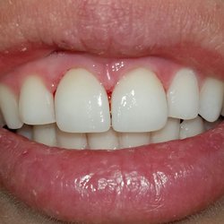 Peter Do DDS - After picture of anterior veneers, which were done in the same day with cerec machine