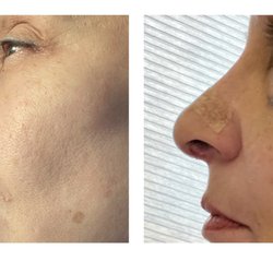 Mitchell Plastic Surgery/Contours and Curves - Rhinoplasty results