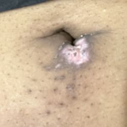 Painless Laser Solutions - Laser burn after effects from "Painless Laser" 2 weeks later...
