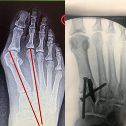 The Foot and Ankle Sports Institute - Bunion Correction