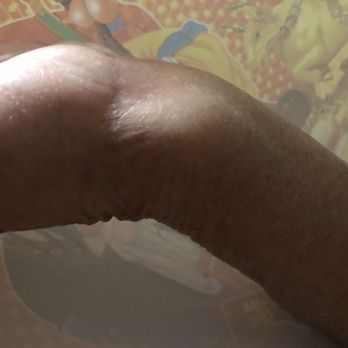 Jeffrey Yao MD - Deformed wrist/hand - Orthopedists Near Me - Redwood City, California Jeffrey Yao MD - Deformed wrist/hand - Orthopedists Near Me - Redwood City, California