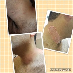 Golden Skin Center - Neck wax hair removal with hard wax @starpil for sensitive areas