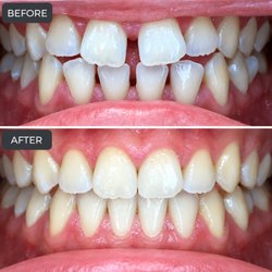 Beautiful smile transformation with Invisalign and teeth whitening.