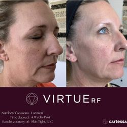 Escape Medical - Results with mirco-needling