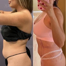 1 week post op abdomen , sides, flanks and back bra roll 1 week post op abdomen , sides, flanks and back bra roll