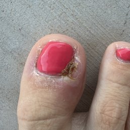 Infected toe Infected toe