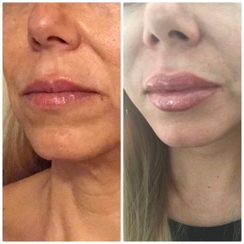 Sammy Sinno, MD - Before. After with my dream lips. - Plastic Surgeons Near Me - Chicago, Illinois
