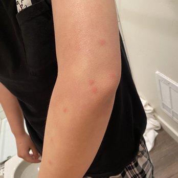 Terra Nova Cabins - Bed bugs bites - Hotels Near Me - West Yellowstone, Montana Terra Nova Cabins - Bed bugs bites - Hotels Near Me - West Yellowstone, Montana