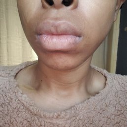 My upper lip after being waved by London.