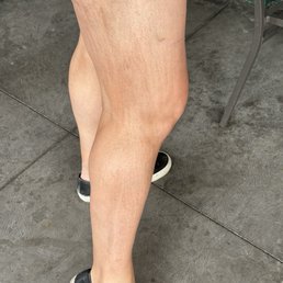 Streaks on my leg Streaks on my leg