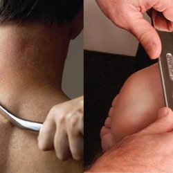 Atwater Chiropractic - IASTM can be used to help alleviate the following symptoms: Limited motion Pain during motion Motor control issues Muscle recruitment issue