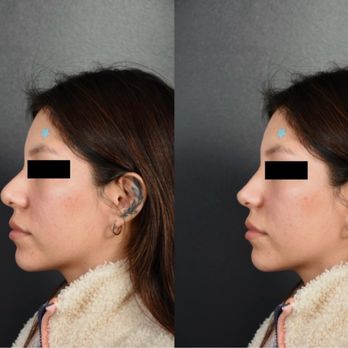 Profiles Beverly Hills - CGI photos created by Dr. Solieman - Cosmetic Surgeons Near Me - Los Angeles, California Profiles Beverly Hills - CGI photos created by Dr. Solieman - Cosmetic Surgeons Near Me - Los Angeles, California
