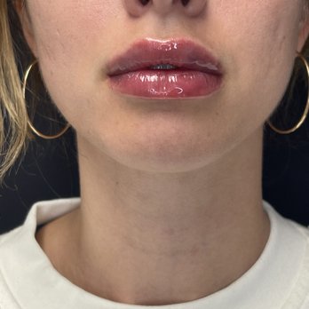 Ageless MD - Lips after! - Medical Spas Near Me - Tustin, California Ageless MD - Lips after! - Medical Spas Near Me - Tustin, California