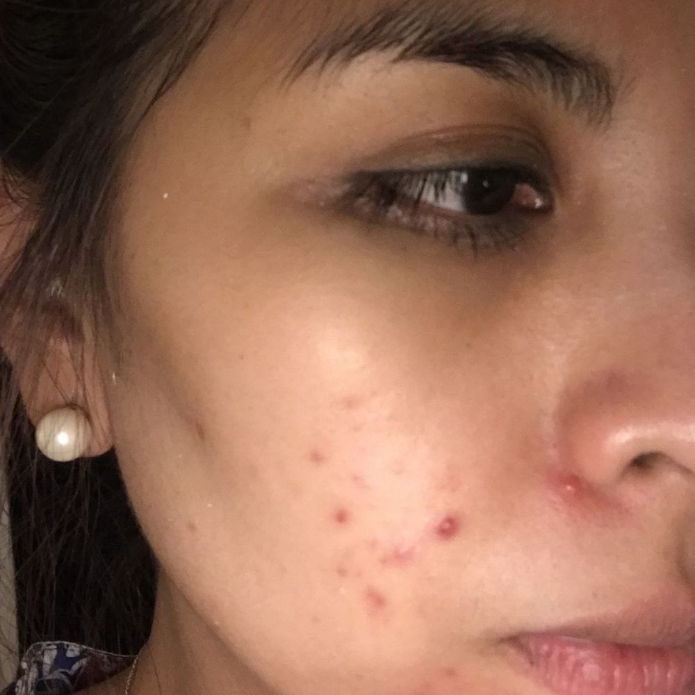 Perfect Glow Skin Care - 4 years ago with bad Cystic Acne prior to meeting Joan - Estheticians Near Me - Carson, California Perfect Glow Skin Care - 4 years ago with bad Cystic Acne prior to meeting Joan - Estheticians Near Me - Carson, California