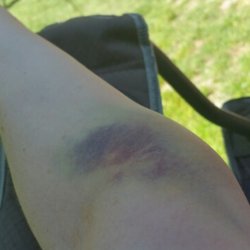 Cure With Care Medical And Dental - Still bruised a full month later.