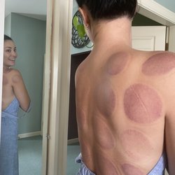 Brunswick Massage and Wellness - Cupping pre massage with Emily, has never felt better!