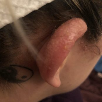 Denton Color Lab - Chemical burns - Hair Extensions Near Me - Denton, Texas