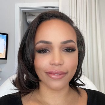 Honey Skincare Studio - After 1 full syringe of filler in upper right side of lip. - Skin Care Near Me - Arlington, Virginia