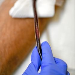 AMA Regenerative Medicine & Skincare - More debris emerging from the patient's blood.