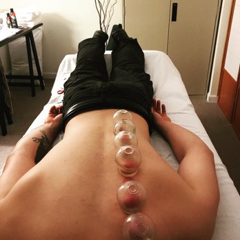 LIV Acupuncture - cupping liv acupuncture pittsford new york - Acupuncture Near Me - Pittsford, New York LIV Acupuncture - cupping liv acupuncture pittsford new york - Acupuncture Near Me - Pittsford, New York