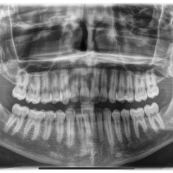 The Center for Excellence in Dentistry - Picture of my X-Rays where Dr. Suarez misdiagnosed me as needing a deep cleaning (and refused to do a regular cleaning).