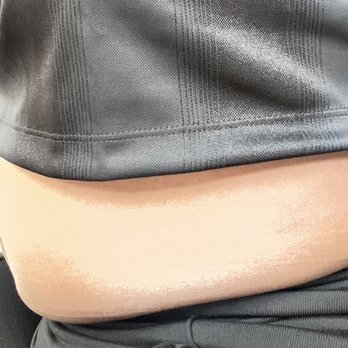 Mia Aesthetics - This is five months after my procedure when I sit down, my stomach is still hanging as you can see - Cosmetic Surgeons Near Me - Brooklyn, New York Mia Aesthetics - This is five months after my procedure when I sit down, my stomach is still hanging as you can see - Cosmetic Surgeons Near Me - Brooklyn, New York