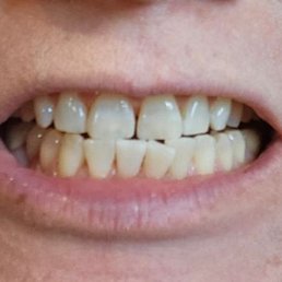 After whitening