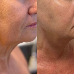 Natalie's Skin Solutions - Radio Frequency Microneedling