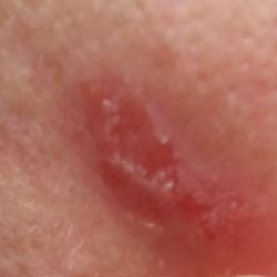 The Skin Clinic - Tiny white plugs....