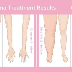 Pankaj Tiwari, M.D - Lymphedema is swelling caused by a build-up of lymph fluid under your skin. It affects your arms or legs.
