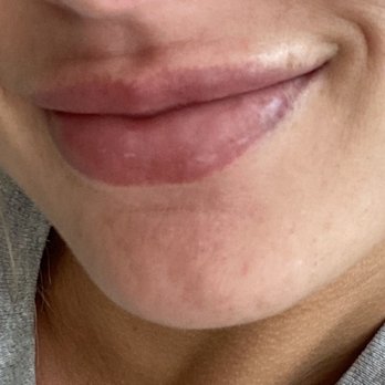DermaTouch RN - Lips by Dina! - Skin Care Near Me - Houston, Texas DermaTouch RN - Lips by Dina! - Skin Care Near Me - Houston, Texas