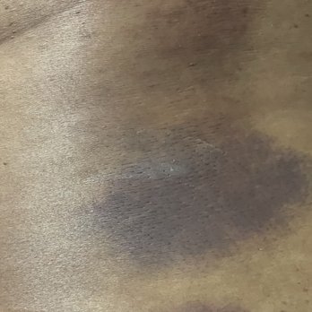 Spa Light - Bruised back - Massage Near Me - Lincoln, Rhode Island Spa Light - Bruised back - Massage Near Me - Lincoln, Rhode Island