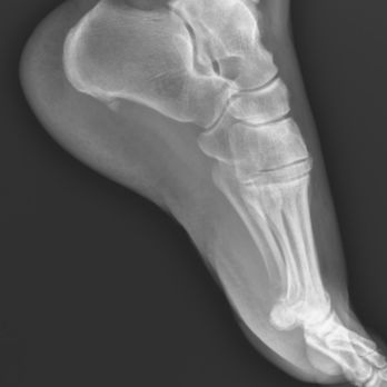 Hanger Prosthetics & Orthotics - My foot is beautiful on the inside... who knew? - Orthopedists Near Me - Rancho Mirage, California Hanger Prosthetics & Orthotics - My foot is beautiful on the inside... who knew? - Orthopedists Near Me - Rancho Mirage, California