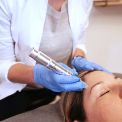 South Carolina Acupuncture Wellness - Microneedling and nanoneedling