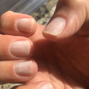 Sao Nails and Spa - Damage to nails with Sao Nails and Spa using drill tool to remove previous gel and also to buff - Cosmetics & Beauty Supply Near Me - Glendale, Colorado Sao Nails and Spa - Damage to nails with Sao Nails and Spa using drill tool to remove previous gel and also to buff - Cosmetics & Beauty Supply Near Me - Glendale, Colorado