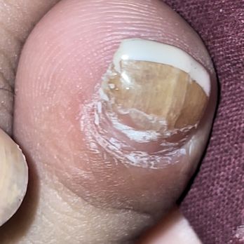 Image Nails - Fungus - Nail Salons Near Me - Houston, Texas Image Nails - Fungus - Nail Salons Near Me - Houston, Texas