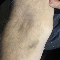 24 hours after the visit to Prime IV in Ormond Beach. They changed arms after this mistake.