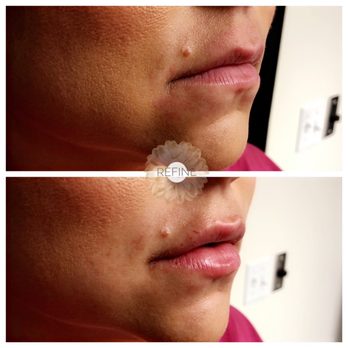 Refine MD Spa - 1 Syringe Juvederm Dermal Fuller Used - Medical Spas Near Me - Bakersfield, California Refine MD Spa - 1 Syringe Juvederm Dermal Fuller Used - Medical Spas Near Me - Bakersfield, California