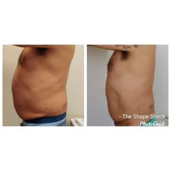 The Shape Shack - Body treatment includes ultrasonics, lipo sculpt, and therma lift. Achieved results over 8 sessions.